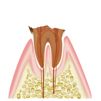 虫歯により歯が崩壊して根っこだけ残った状態（C4）