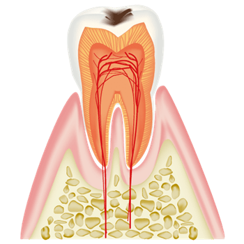 初期の虫歯（C1）
