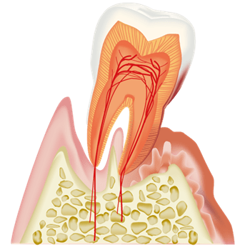 重度歯周炎（重度の歯周病）